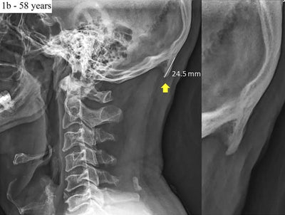 Cell phone usage can lead to horns growing -- doctors say